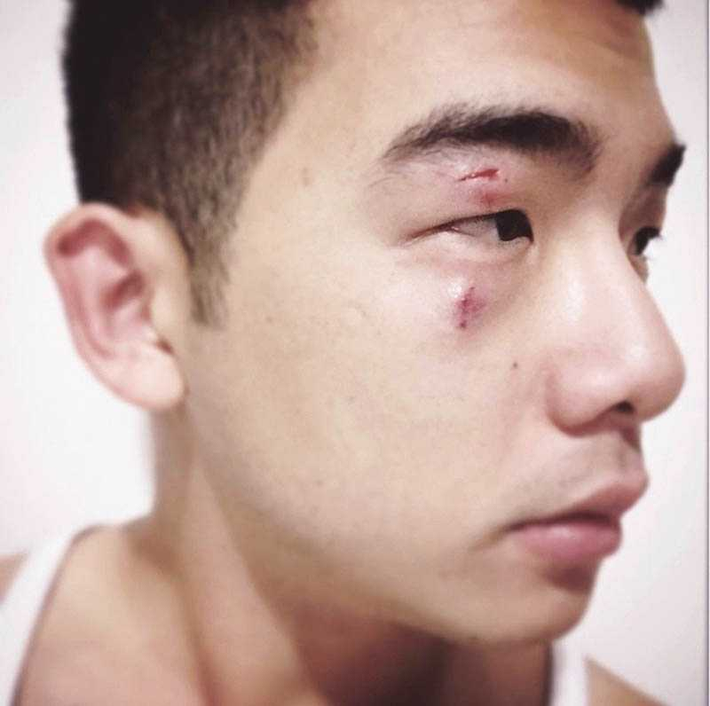 還沒改名之前，Lucky常莫名攻擊胡瑋杰，曾把他眼皮咬傷。（圖／胡瑋杰提供）