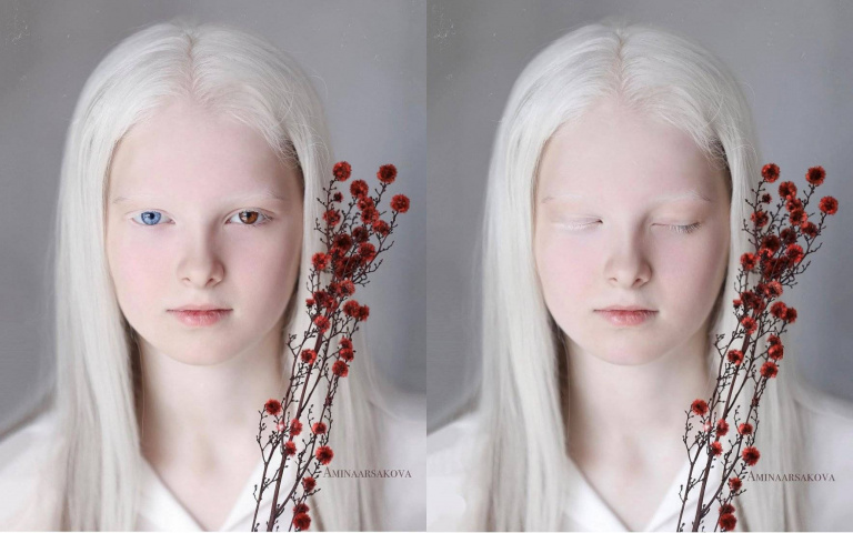 世界上真的有天使！車臣女孩因罕病擁有雪白長髮與異色雙瞳，美貌震撼全球