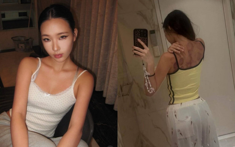 擁有火辣身材卻愛老中醫這味？小S女兒Elly曬「滿背暗紅圓印」被笑：在過老人生活！