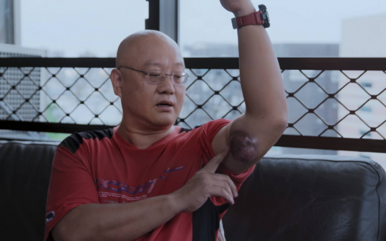 曾寶儀至親罹骨肉瘤 手臂長大肉瘤開刀「挖大腿來補」